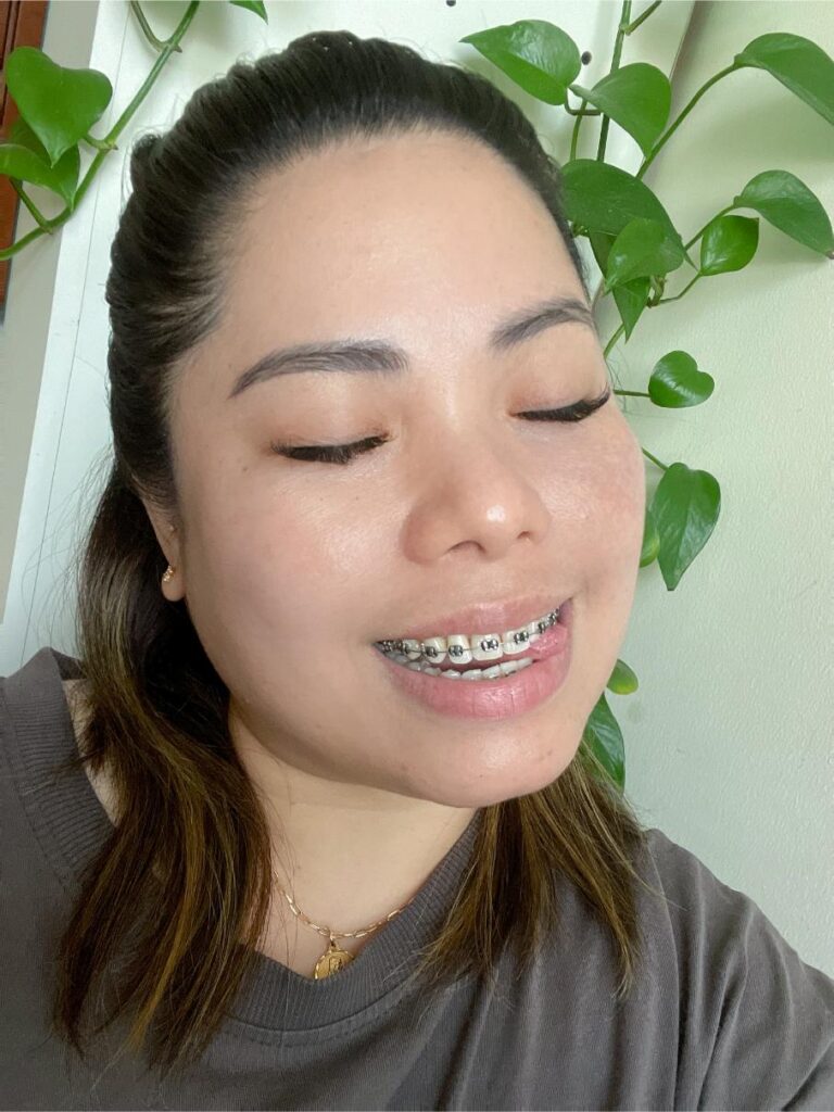 orthodontie adolescence